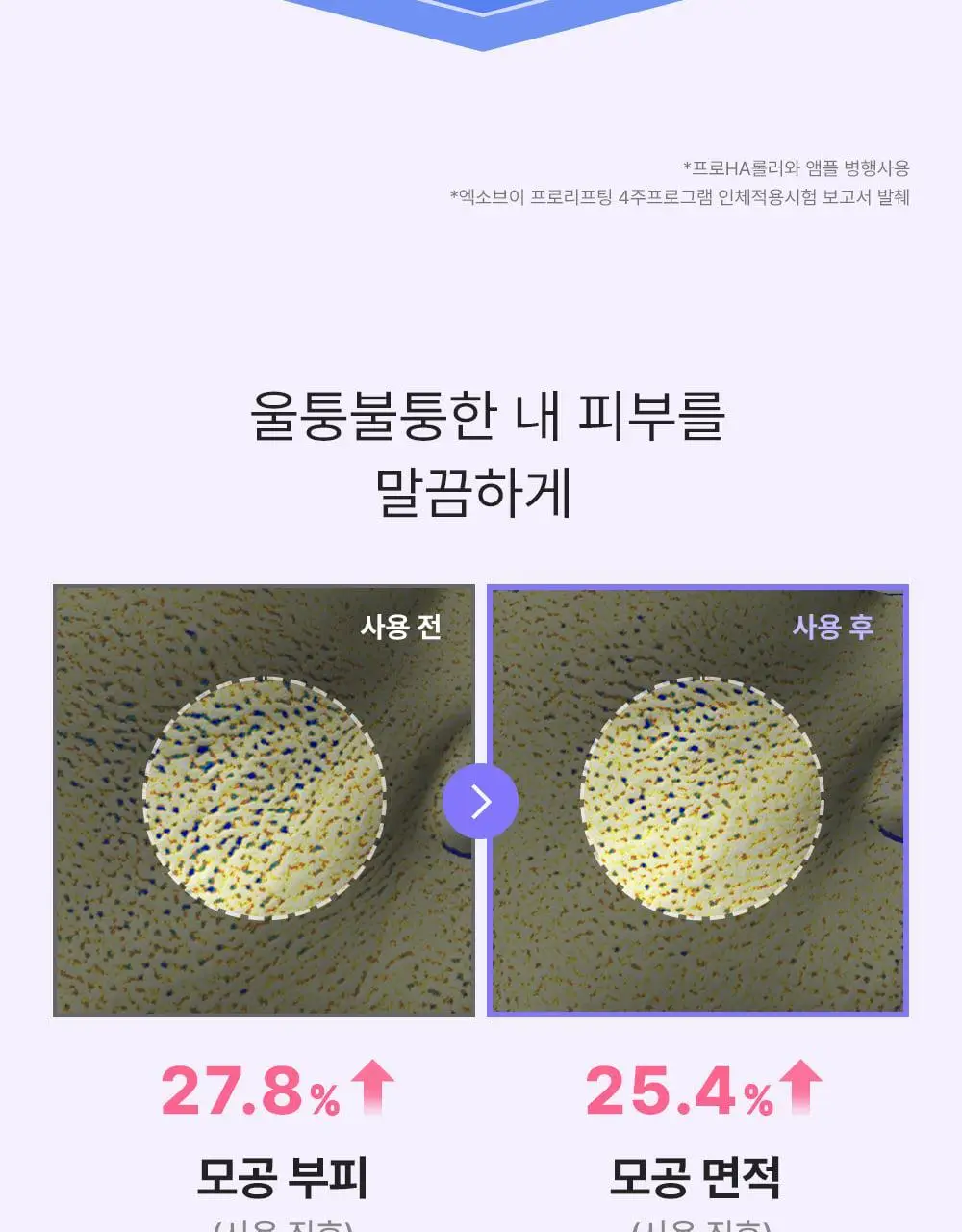 [모공교정] 아이디플라코스메틱 엑소브이 프로리프팅 세트(리프팅 앰플 5ml + MTS 롤러) 상세페이지 33